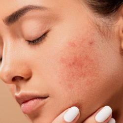 Cum sa scapi mai usor de acnee